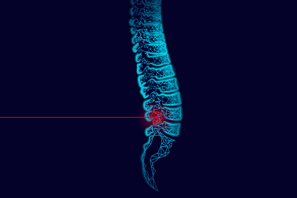 laser spine surgery Palm Harbor, FL